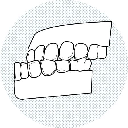 illustracio-dentadura-mossegada Il·lustració de dents inferiors més avançats que els superiors