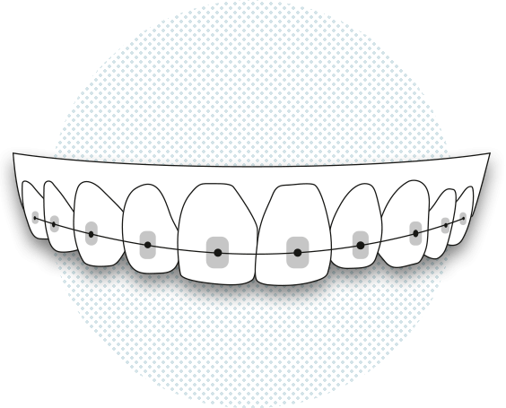Ortodoncia con brackets Barcelona