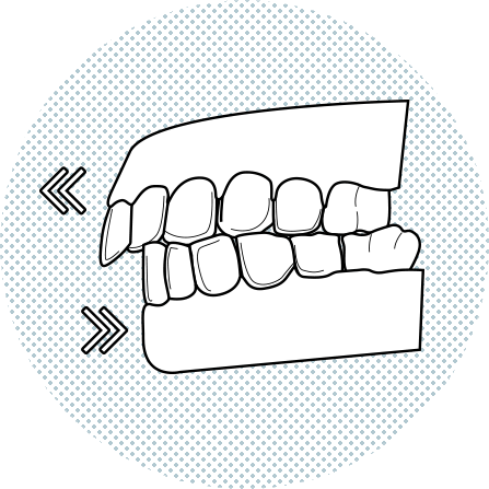 Maloclusión dental Barcleona Maloclusión dental Barcleona
