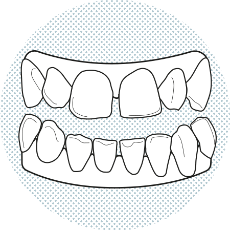Dientes separados Barcelona Dientes separados Barcelona