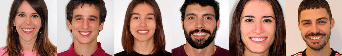 Primer plano de pacientes de Ortodoncia Tres Torres para introducir Invisalign® antes y después. Primer plano de pacientes de Ortodoncia Tres Torres para introducir Invisalign antes y después.